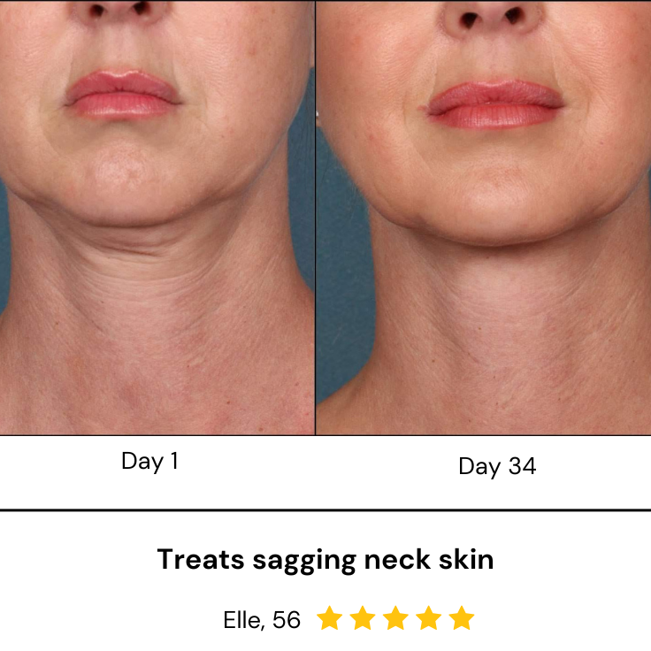 ESSEN LED Phototherapy Neck mask - treat sagging skin and wrinkles