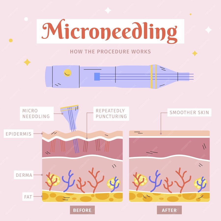 Electric Microneedling Pen - Acne Scar Treatment