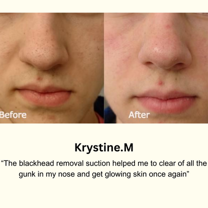 Blackhead Removal effective treatment tool - Blackhead removal suction